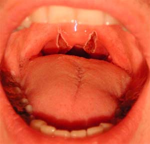 Brian's Snoring Surgery - UPPP, Tonsillectomy, and Genioglossus Tongue